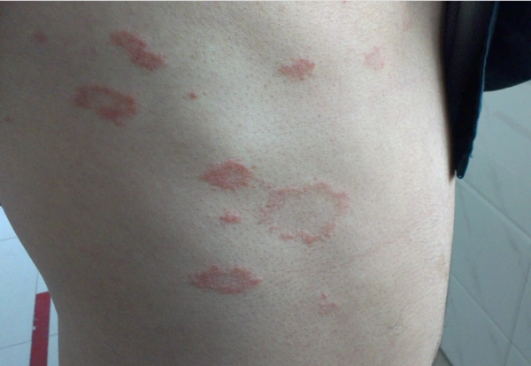 陈先生做了肝癌切除手术后,病情就稳定下来了,两周后陈先生身上的红斑