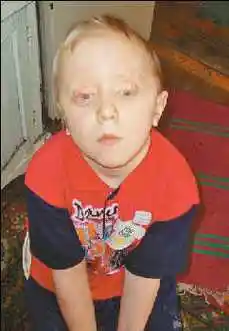 俄罗斯男童基因突变长四只眼睛(组图)