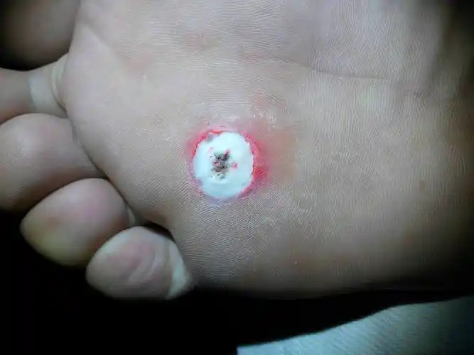 鸡眼怎么治疗(鸡眼挖干净后的样子)