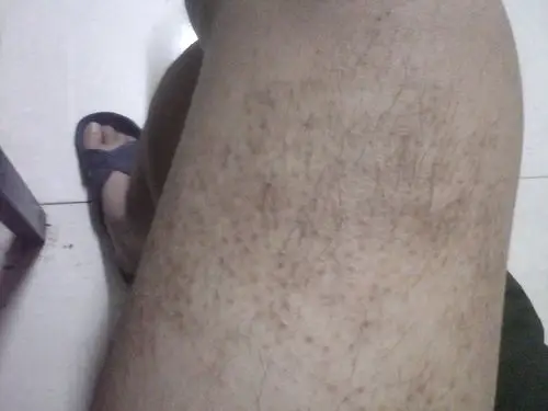 大腿有黑色的点子,里面长毛,但很难看,能消除吗