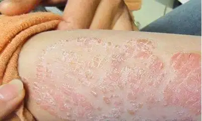病毒性皮肤病有哪几种图片