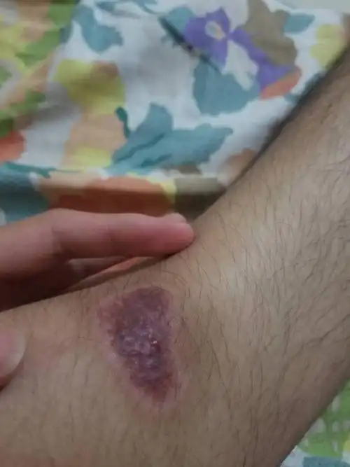 伤口结痂脱落后,过了20天现在变成这样是怎么回事