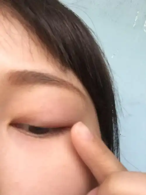 我左眼昨天突然有点痛今天就肿了上眼皮,不知道怎么回事?求解