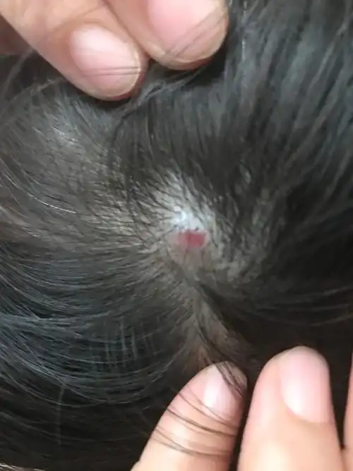 头皮上长了个疙瘩红色的