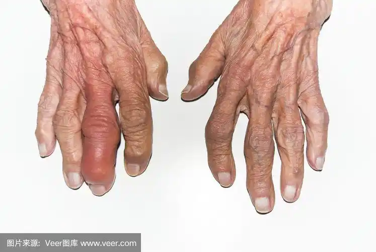 手指,老年女人,肿胀的,平衡折角灯,骨关节炎