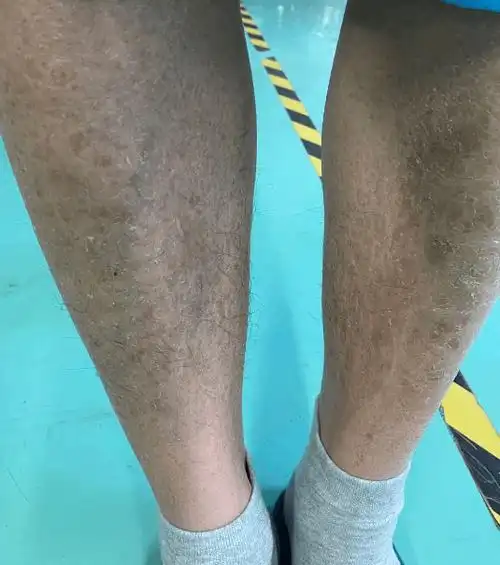 严重,就不去治疗,其实这种做法是不正确的,夏季治疗皮肤鱼鳞病才是