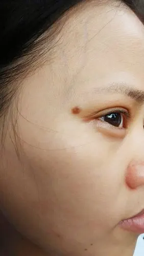 问:女性,右眼角的这痣有什么特殊意义吗,想把它弄掉有什么影响不?