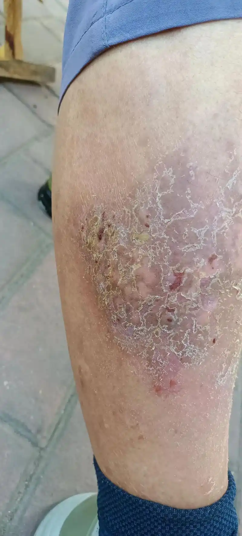 牛皮癣#皮肤病#湿疹#过敏#完美收官.#传承中医文化 #分享 - 抖音