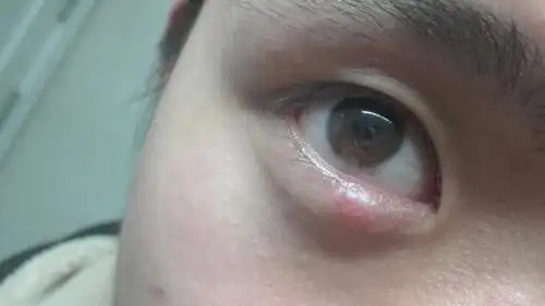 下午眼皮肿怎么回事 下眼皮肿是怎么回事呢