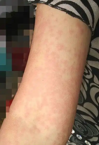 身上起红疙瘩,一片一片的,主要在四肢.很痒