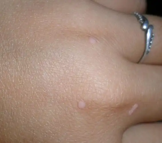 扁平疣图片_扁平疣症状表现图片大全_有来医生