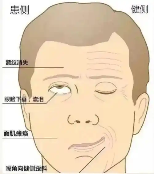 【健康科普】关于面神经炎