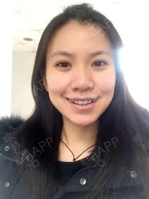 拔了虎牙后面两颗牙 拔前这样