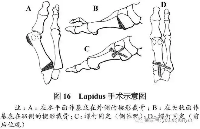 该手术结合远端软组织手术,适用于ima>16°的重度拇外翻的治疗