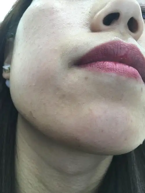 过敏好了之后用的理肤泉特安的护肤品!用上之后就开始起疙瘩!一天