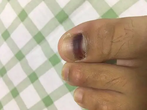 我的左脚大拇指指甲出现紫黑色一块,没有收到挤压啊,按压也不痛,请问