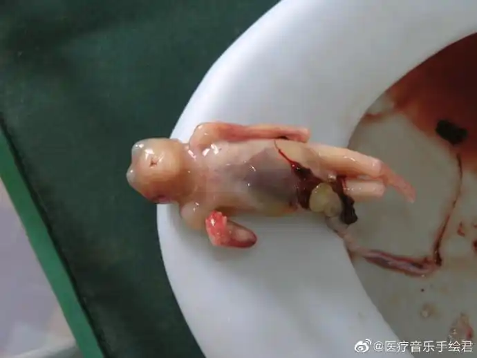 点滴医事#医生医事#胎儿畸形:无脑儿引产.