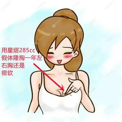 我用星熠假体隆胸一年后很软没有硬