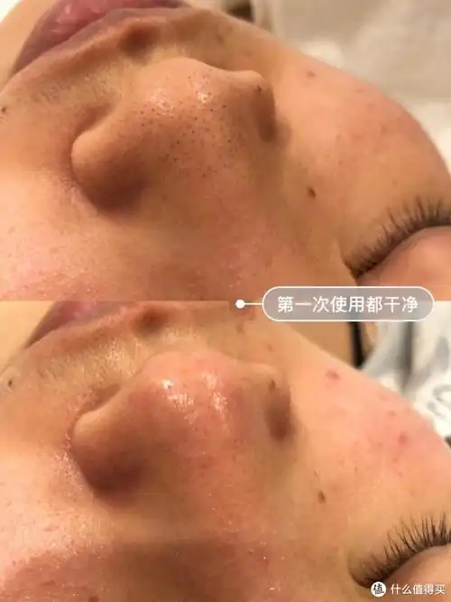 小气泡去黑头是最最有效的去黑头办法但凡去美容院做过小气泡的朋友