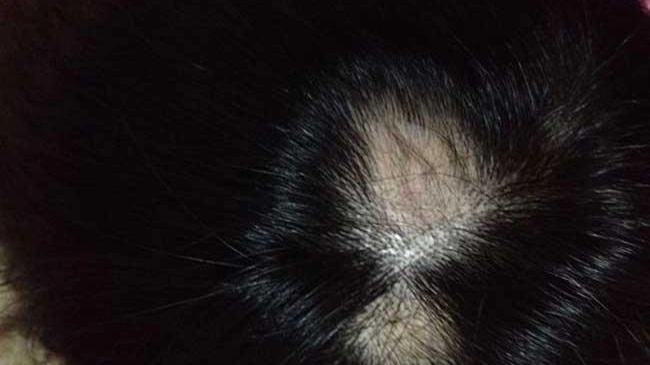 儿童脱发,小心"拔毛癖"