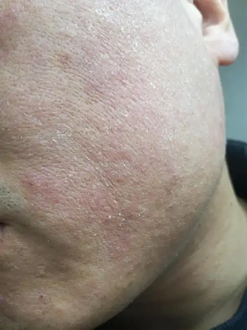 脸上痒 起皮 头皮屑多 - 皮肤及性传播疾病讨论版 - 爱爱医医学论坛