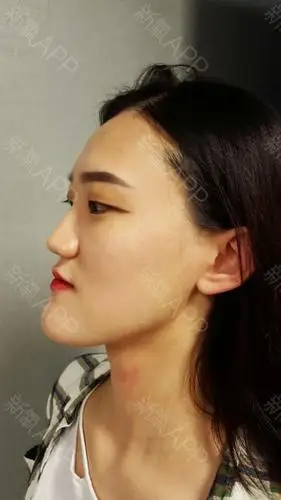 撅下巴终于不见啦!终于不_圈子-新氧美容整形