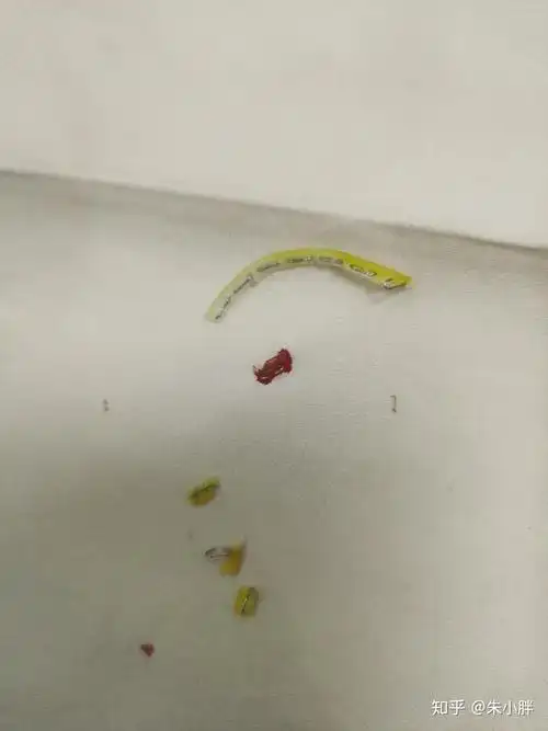 吻合器割包皮术后恢复及取钉分享