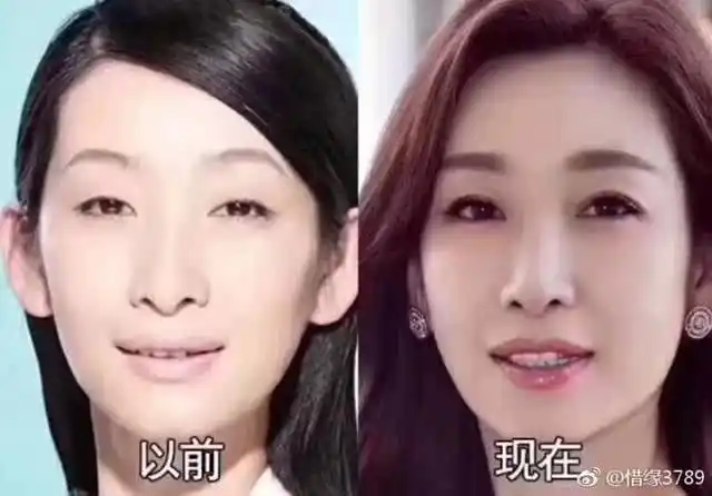 为单眼皮买保险的秦海璐如今也割双眼皮背后原因万万没想到