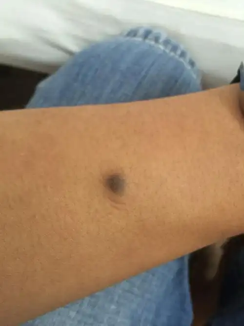 手臂上最近长出了这个黑点,已经有快一年了,好像是毛孔堵住了一样