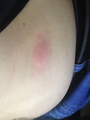 请问这是什么疙瘩. 什么原因? 谢谢