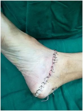 脚被电锯切到,差点掉了