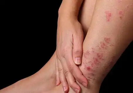 银宵癣图片 牛皮癣图早期症状