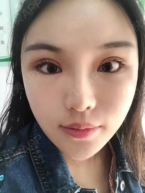 自体脂肪填泪沟术后16天_吸脂瘦大腿术后16天_自体脂肪面部填充术后16