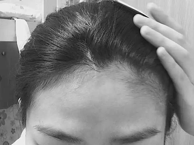 发际线太低是怎样的体验?