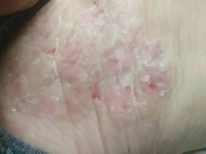 手脚上先是出现深色小点,然后就角质化,而且逐渐增厚,角质太厚的时候