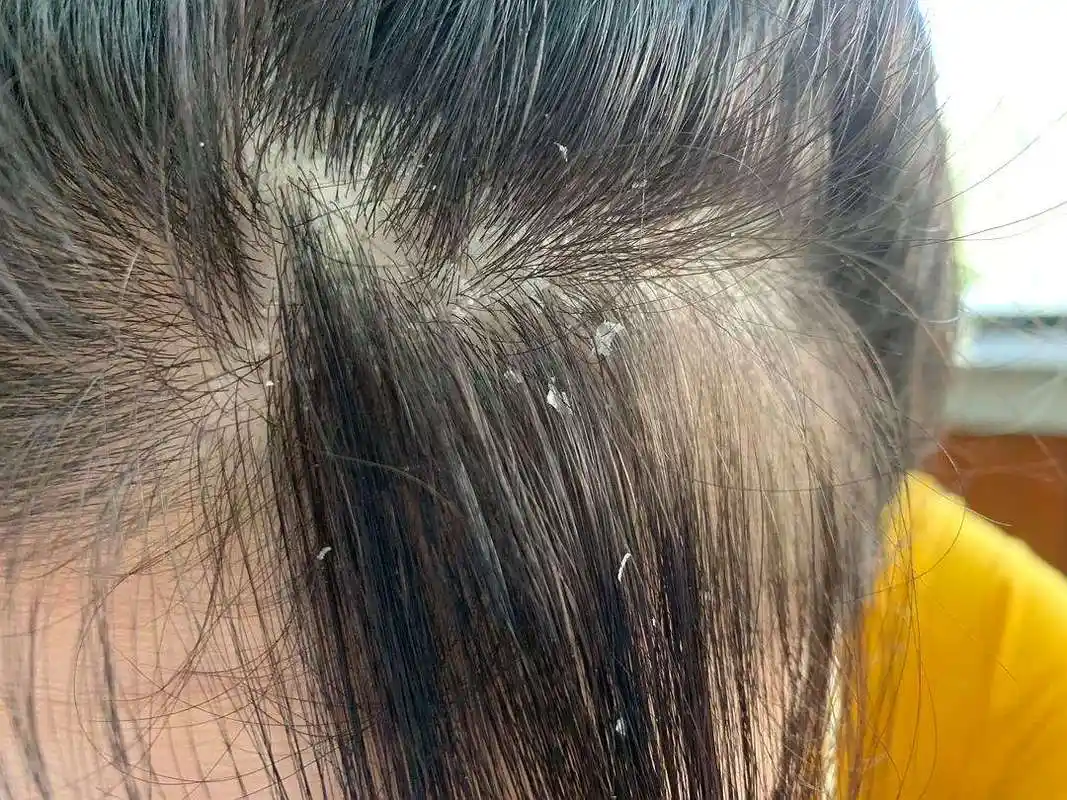头皮痒,头屑多,会不会是银屑病?怎么治,医生一次给你讲清楚