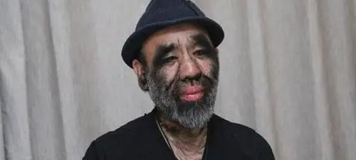 浑身长满长毛被誉为小野人43年过去他的现状怎么样了