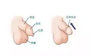 包皮长自己天天注意事项才能不长