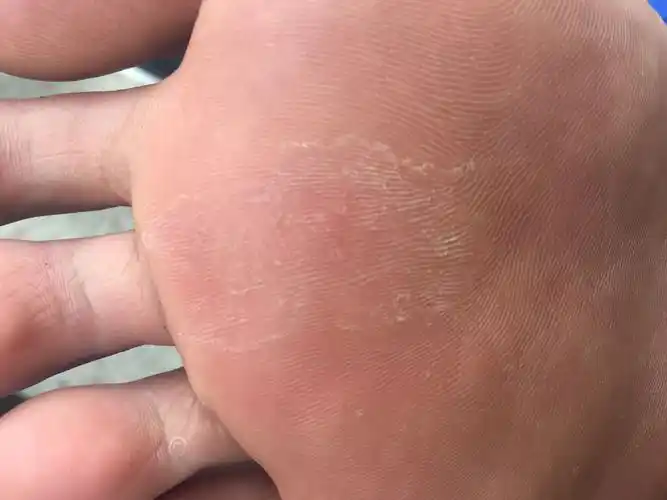 10 脚底皮肤痒没有水泡 以前没有那么大面积的现在很痒