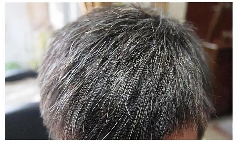 如果你还年轻,也有白发的问题,不妨在日常饮食中补充这4种营养素,或许