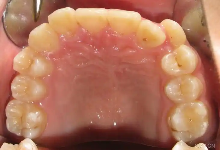 【病例讨论】下中切牙缺失 [病例帖]