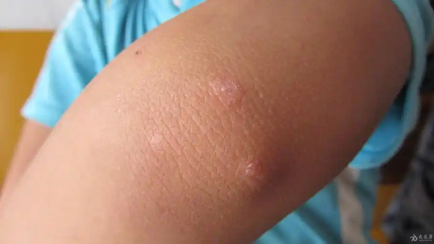 神经性皮炎 - 皮肤及性传播疾病讨论版 - 爱爱医医学论坛