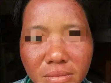 盘状红斑狼疮的症状和图片 - 有来医生