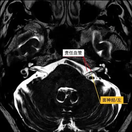 头部mri:可见左侧面神经周围责任血管压迫.