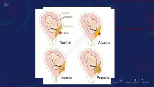 胎盘植入性疾病mri诊断