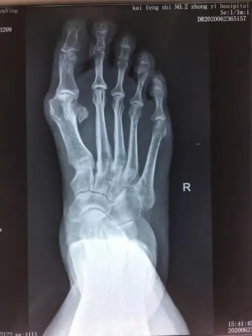 足底行走痛 原来是"大脚骨"惹的祸