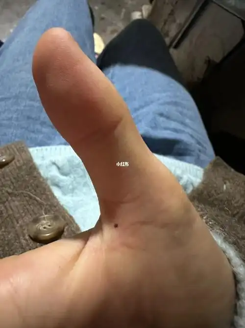 笔记灵感  大拇指突然长了一颗痣是怎么回事啊有谁知道突然就有了擦
