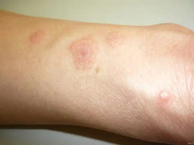 典型病例多形红斑