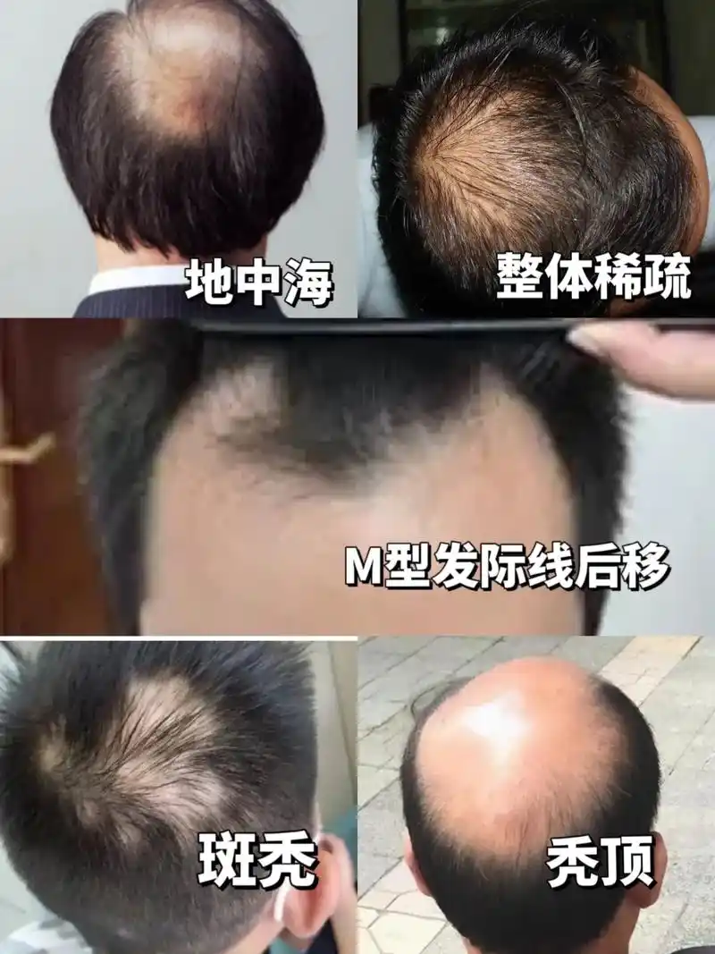 几种常见的脱发类型怎么选假发?
