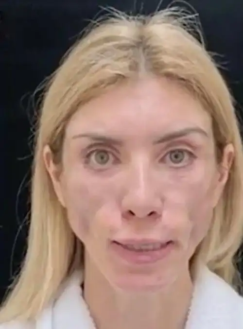 哭死41岁选美小姐整形失败竟变死人脸一闭眼吓死人再也不能笑